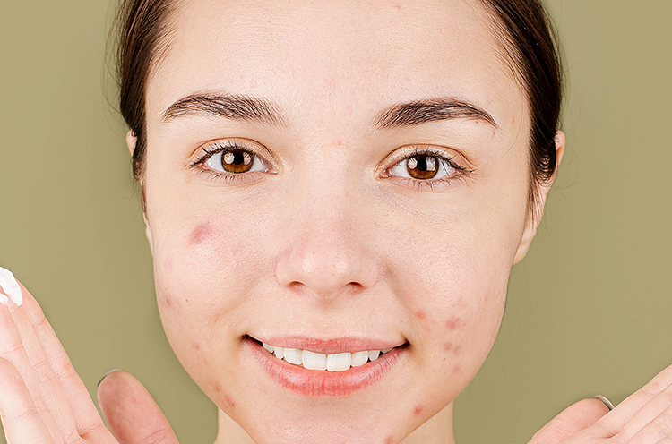 Tips and Remedies to Prevent Acne Naturally