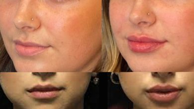 Lip Filler Before And After Thin Lips